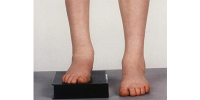 長短腿矯正術(shù)前