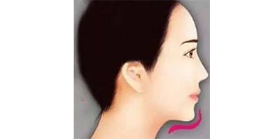 假體豐下巴術(shù)后