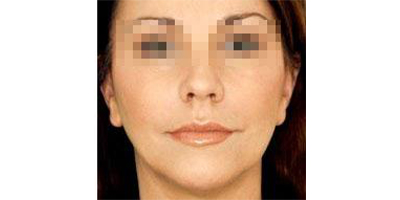 玻尿酸去面部細(xì)紋術(shù)后