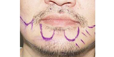 種植胡須術(shù)前