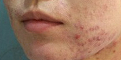 海菲秀皮膚護理術前