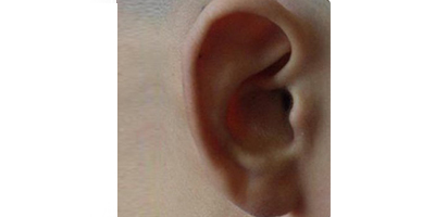 耳再造術(shù)后