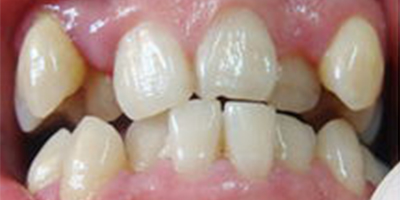 舌側(cè)矯正術(shù)前