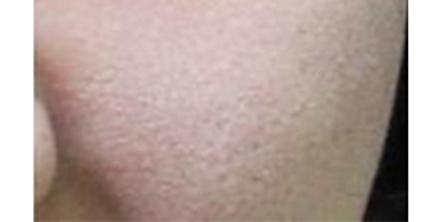 玻尿酸導入術前