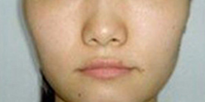 自體脂肪全臉填充術(shù)前