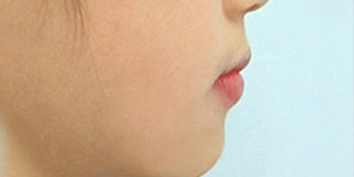 隱形矯正術(shù)后