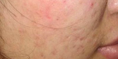 紅藍光祛痘術后