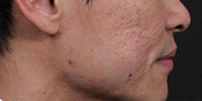 點陣激光術(shù)前