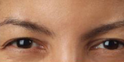 注射去鼻背紋術(shù)后