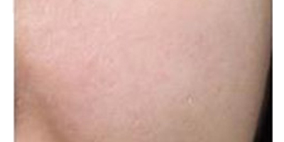 玻尿酸導入術后