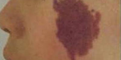 手術(shù)去胎記術(shù)前