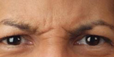 注射去鼻背紋術(shù)前