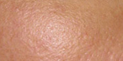 黃金微針術(shù)前