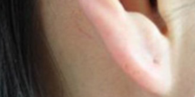 玻尿酸豐耳垂術(shù)后