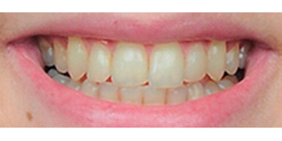 超聲波洗牙術前