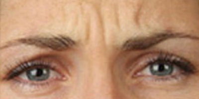 注射去川字紋術(shù)前