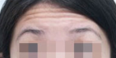 注射去面部細紋術前