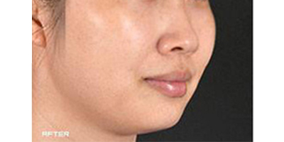 皮秒激光術(shù)后