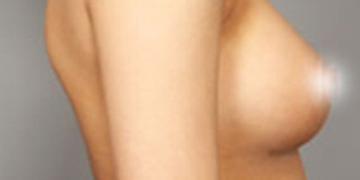 復(fù)合隆胸術(shù)后