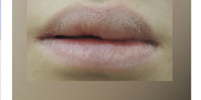 溶解酶術(shù)前