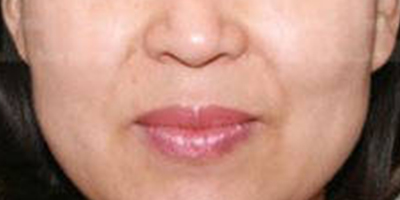 按摩緊致術(shù)前