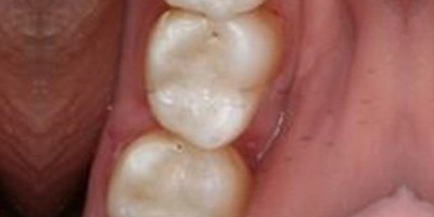 根管治療術(shù)后