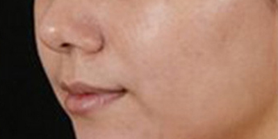 像素激光術(shù)后