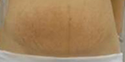 去妊娠紋術(shù)前