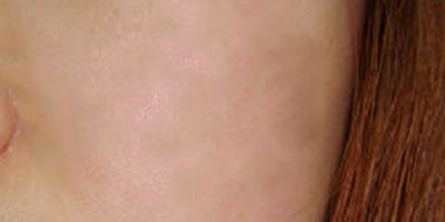 激光祛紅血絲術(shù)后