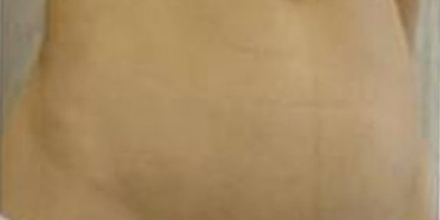 去妊娠紋術(shù)后