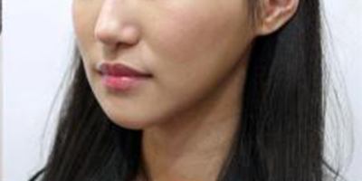 下巴硅膠假體取出術后