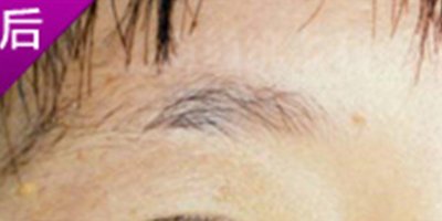 洗眉術后