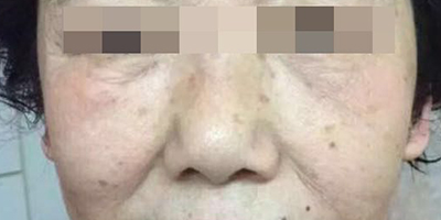 精華導(dǎo)入術(shù)后