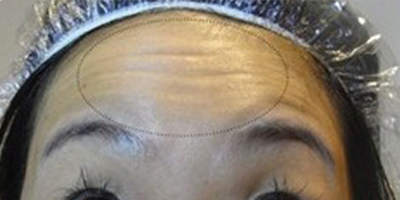 注射去動態(tài)紋術(shù)前