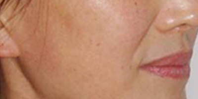 自體脂肪去法令紋術(shù)前