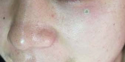 激光點(diǎn)痣術(shù)后