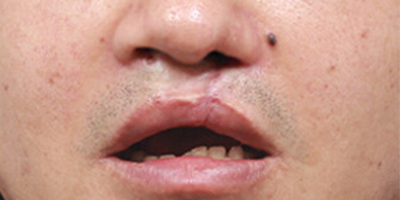 唇腭裂手術(shù)術(shù)后