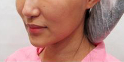 下巴硅膠假體取出術前