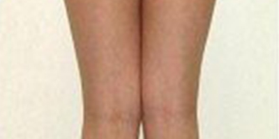 吸脂失敗修復術后