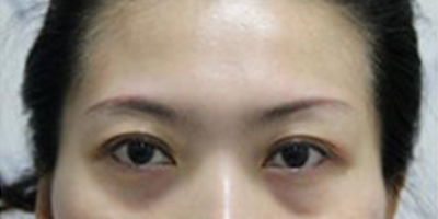 自體脂肪豐太陽穴術(shù)前