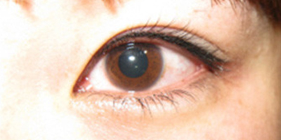 半永久紋眼線術(shù)后