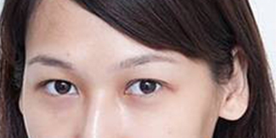 自體脂肪豐淚溝術(shù)后