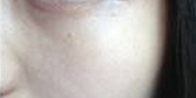 玻尿酸導(dǎo)入術(shù)后