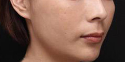 少女針術(shù)后