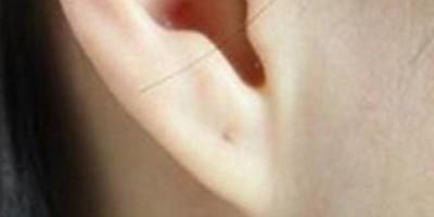 玻尿酸豐耳垂術(shù)前