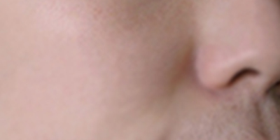 射頻微針術(shù)后