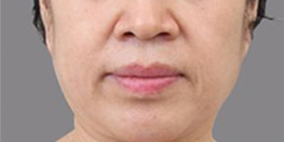 PRP美塑美膚術(shù)前