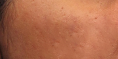 離子束激光術(shù)后