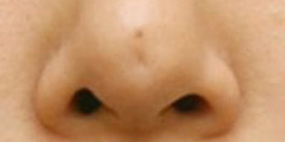 鼻部修復(fù)術(shù)前