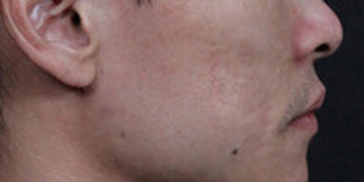 點陣激光術(shù)后